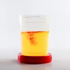 Contenitore con campione di urine di cane. Si nota una leggera presenza di sangue, che crea striature rosse nell'urina gialla.
