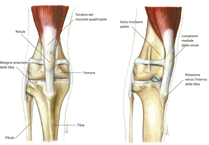 Illustrazione anatomica del ginocchio di un cane, che mostra la rotula in posizione normale e una lussazione mediale della rotula, con rotazione interna della tibia.