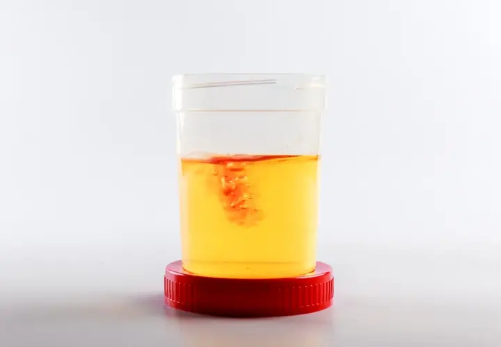 Contenitore con campione di urine di cane. Si nota una leggera presenza di sangue, che crea striature rosse nell'urina gialla.