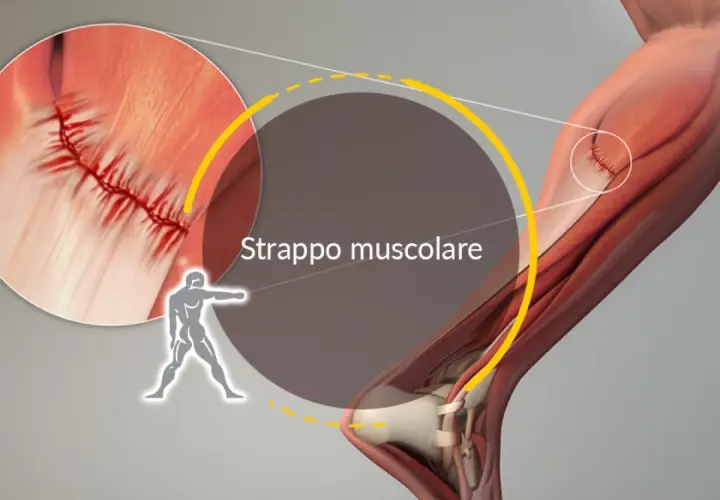 Dettaglio anatomico di uno strappo muscolare, con suture visibili. I sintomi di uno strappo muscolare nel cane possono includere zoppia e dolore.