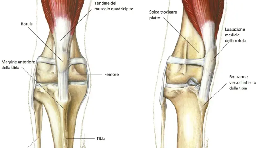 Illustrazione anatomica del ginocchio di un cane, che mostra la rotula e il femore. A destra, la lussazione mediale della rotula, una condizione che può richiedere un intervento chirurgico. Il costo dell'intervento per la lussazione rotula cane varia.