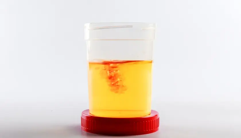 Contenitore con campione di urine di cane. Si nota una leggera presenza di sangue, che crea striature rosse nell'urina gialla.