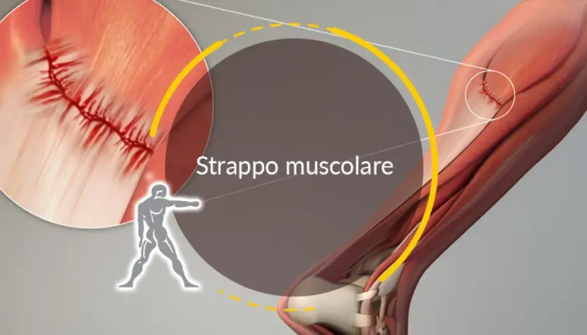 Dettaglio anatomico di uno strappo muscolare, con suture visibili. I sintomi di uno strappo muscolare nel cane possono includere zoppia e dolore.