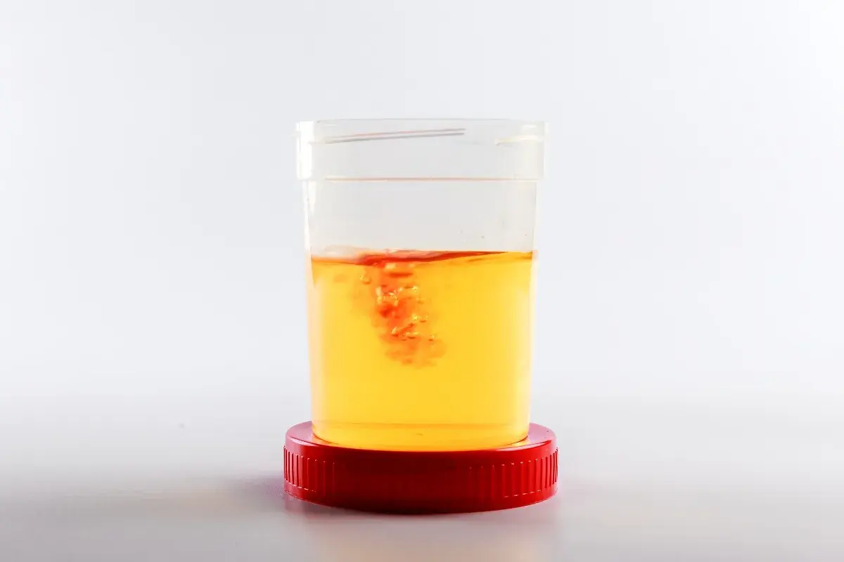Contenitore con campione di urine di cane. Si nota una leggera presenza di sangue, che crea striature rosse nell'urina gialla.
