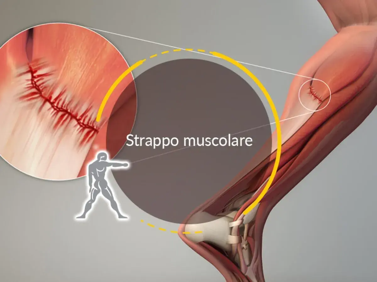 Dettaglio anatomico di uno strappo muscolare, con suture visibili. I sintomi di uno strappo muscolare nel cane possono includere zoppia e dolore.