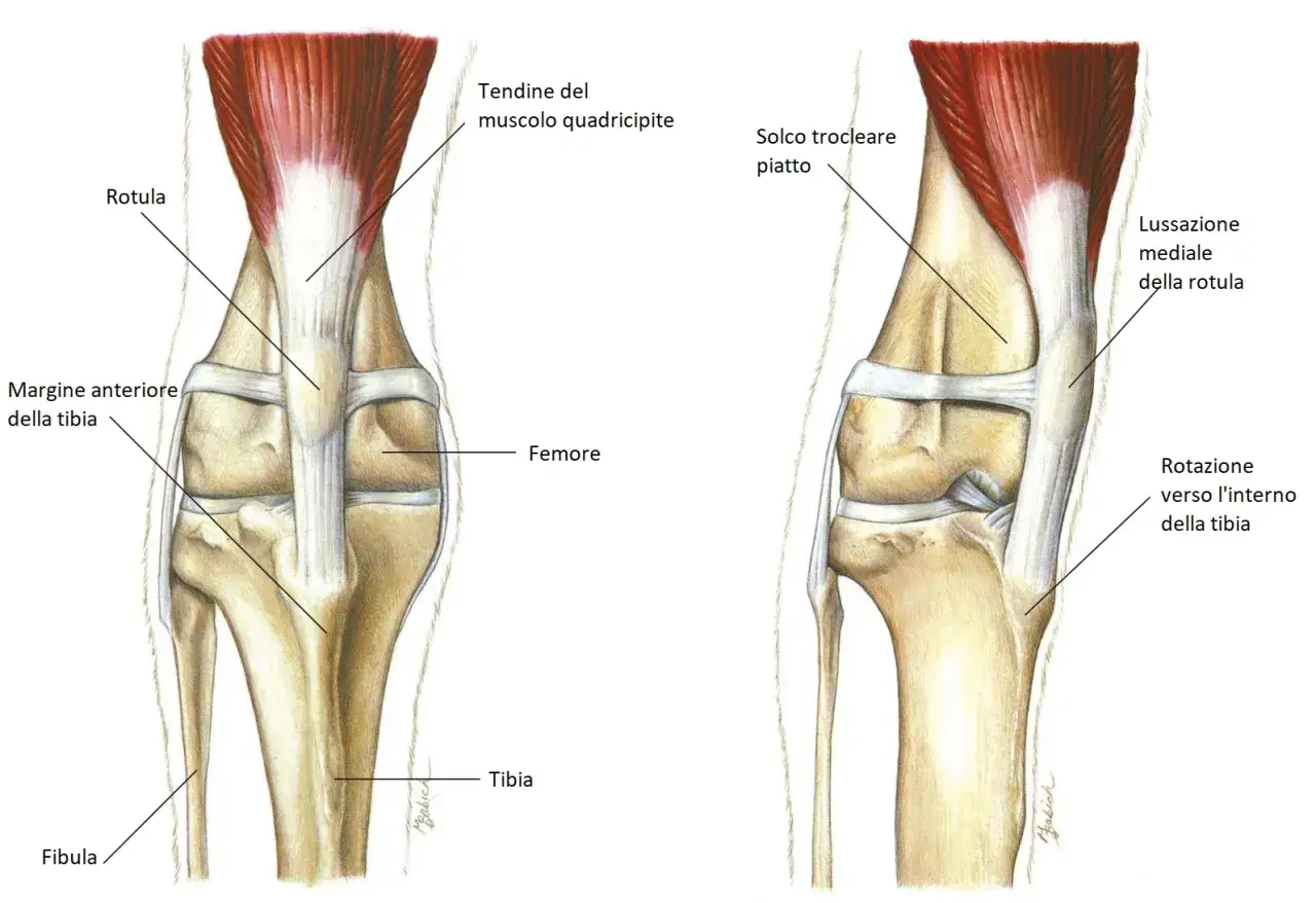 Illustrazione anatomica del ginocchio di un cane, che mostra la rotula, il femore e la tibia. Un'immagine evidenzia la lussazione mediale della rotula.